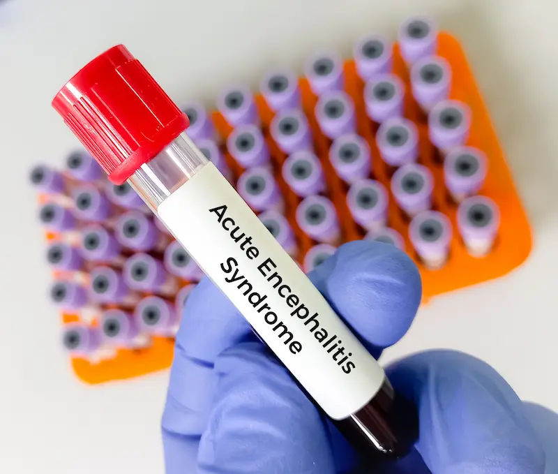 Acute Encephalitis Syndrome (AES) A Complete Guide